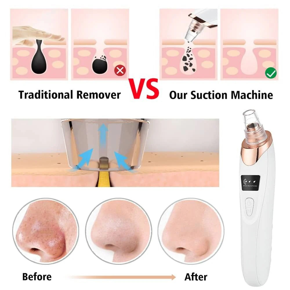 Blackhead Remover Machine